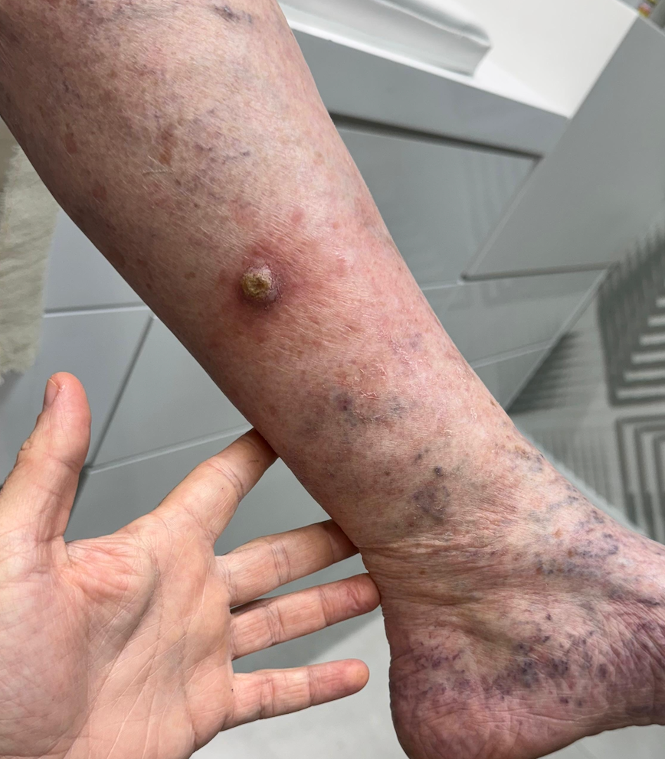 Carcinoma Espinocelular no antebraço — lesão elevada com crosta