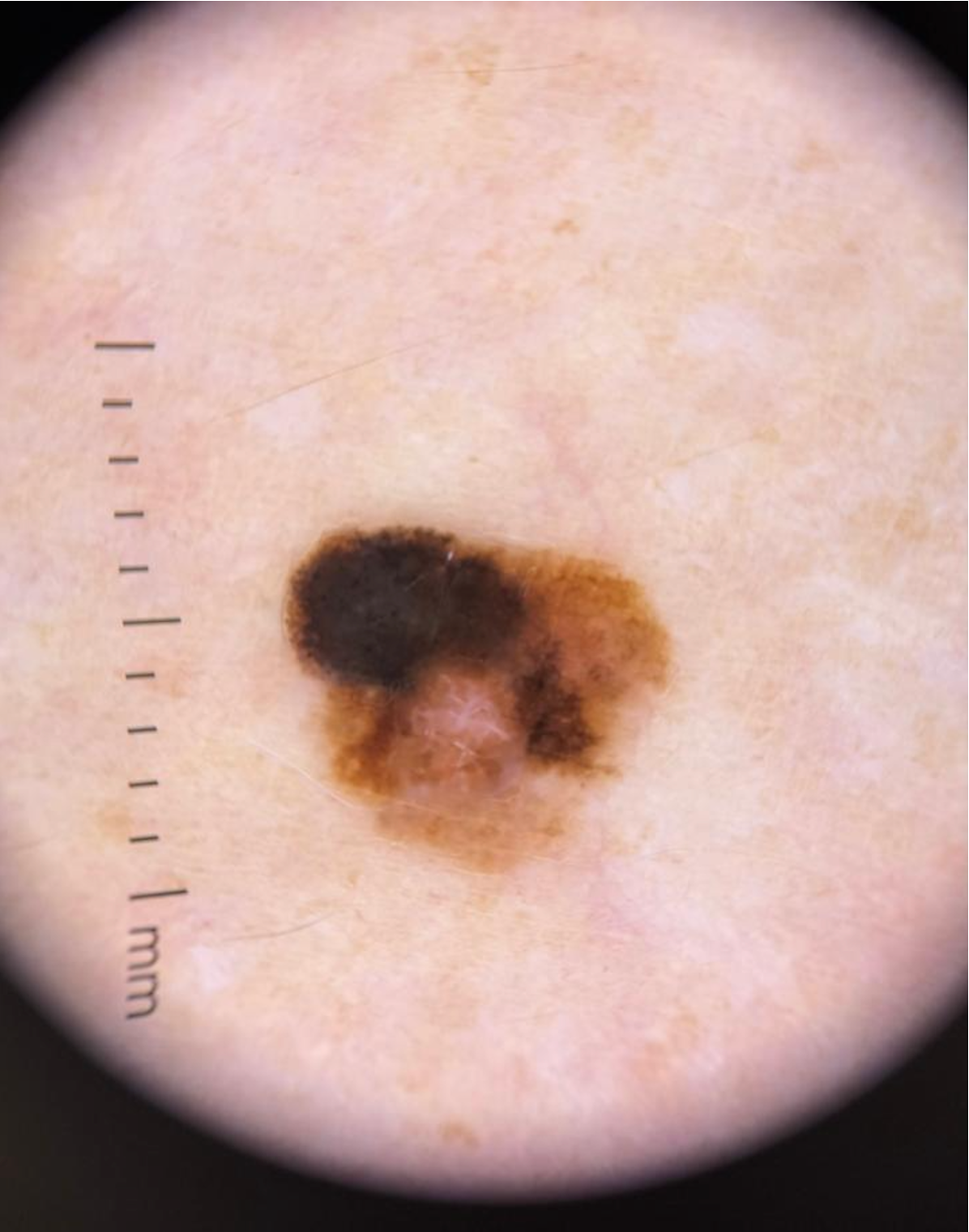 Melanoma visto à dermatoscopia — variação de cores e assimetria